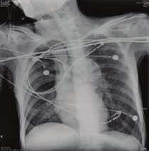 一位肺炎病人成功脫離呼吸器之照護經驗 七 住院治療經過 7/6 ICU 1 1.