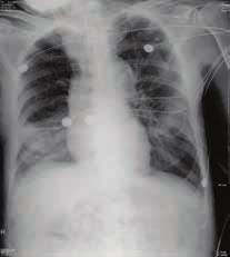 一位肺炎病人成功脫離呼吸器之照護經驗 7/14 ICU 9 GCS E VeM 82 / 125/72 mmhg21