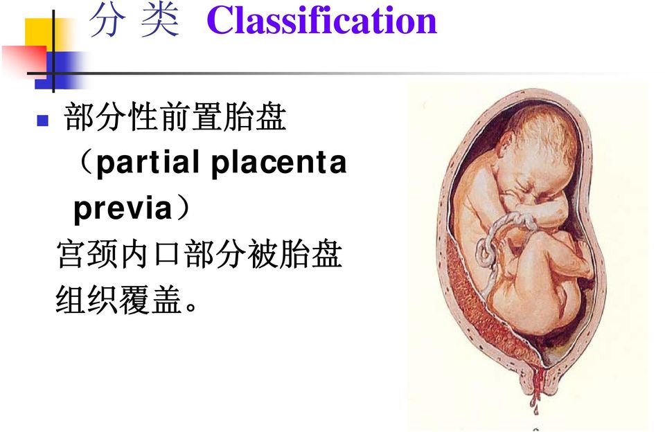 placenta previa) 宫 颈