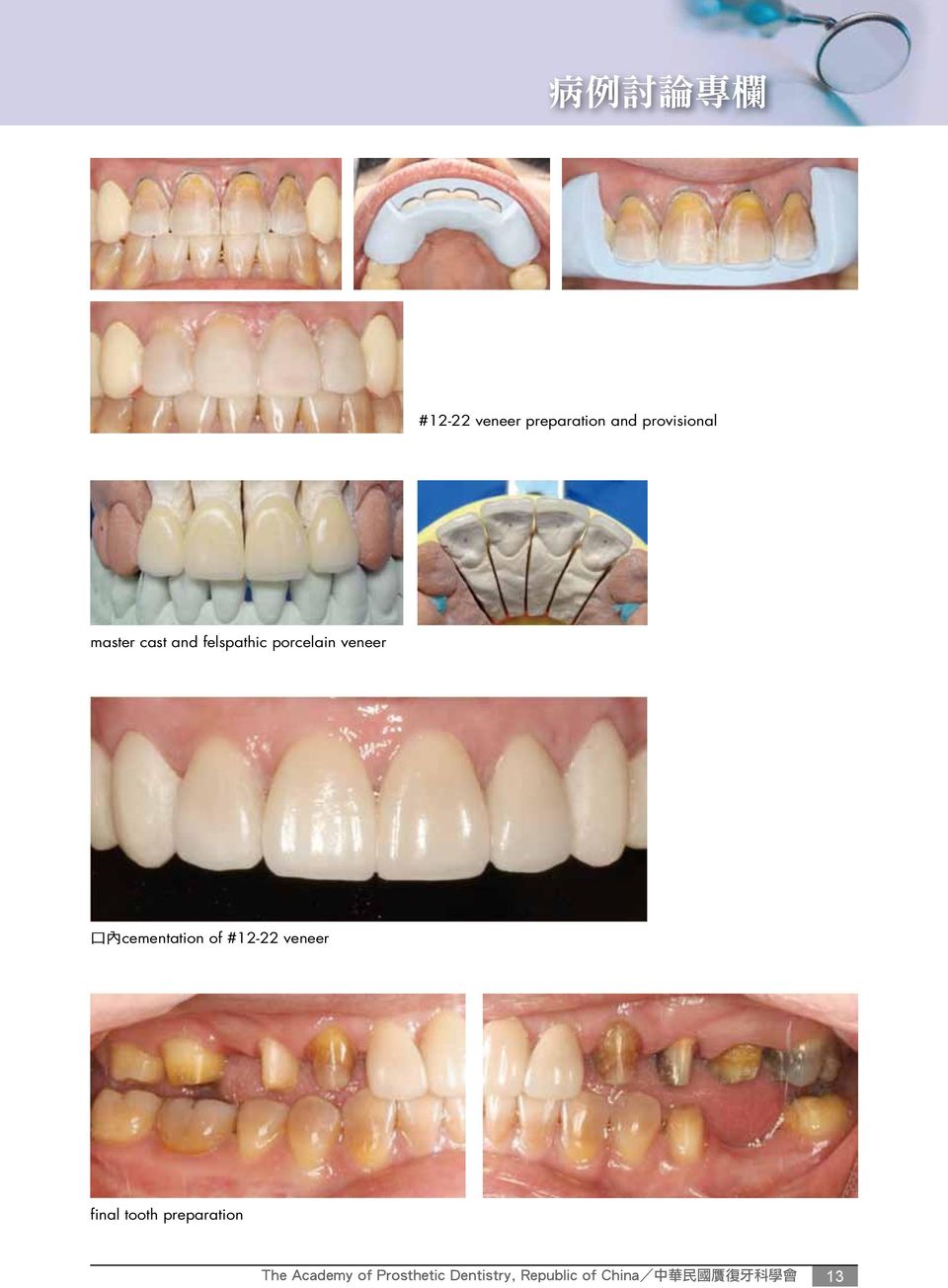 of #12-22 veneer final tooth preparation The Academy of