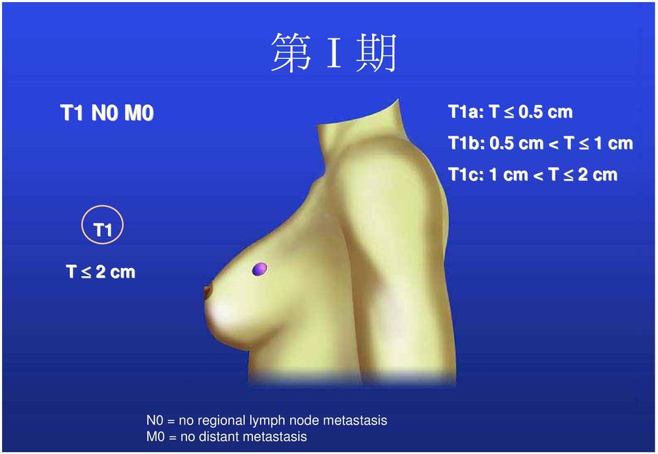 T1 T 2 cm N0 = no regional lymph