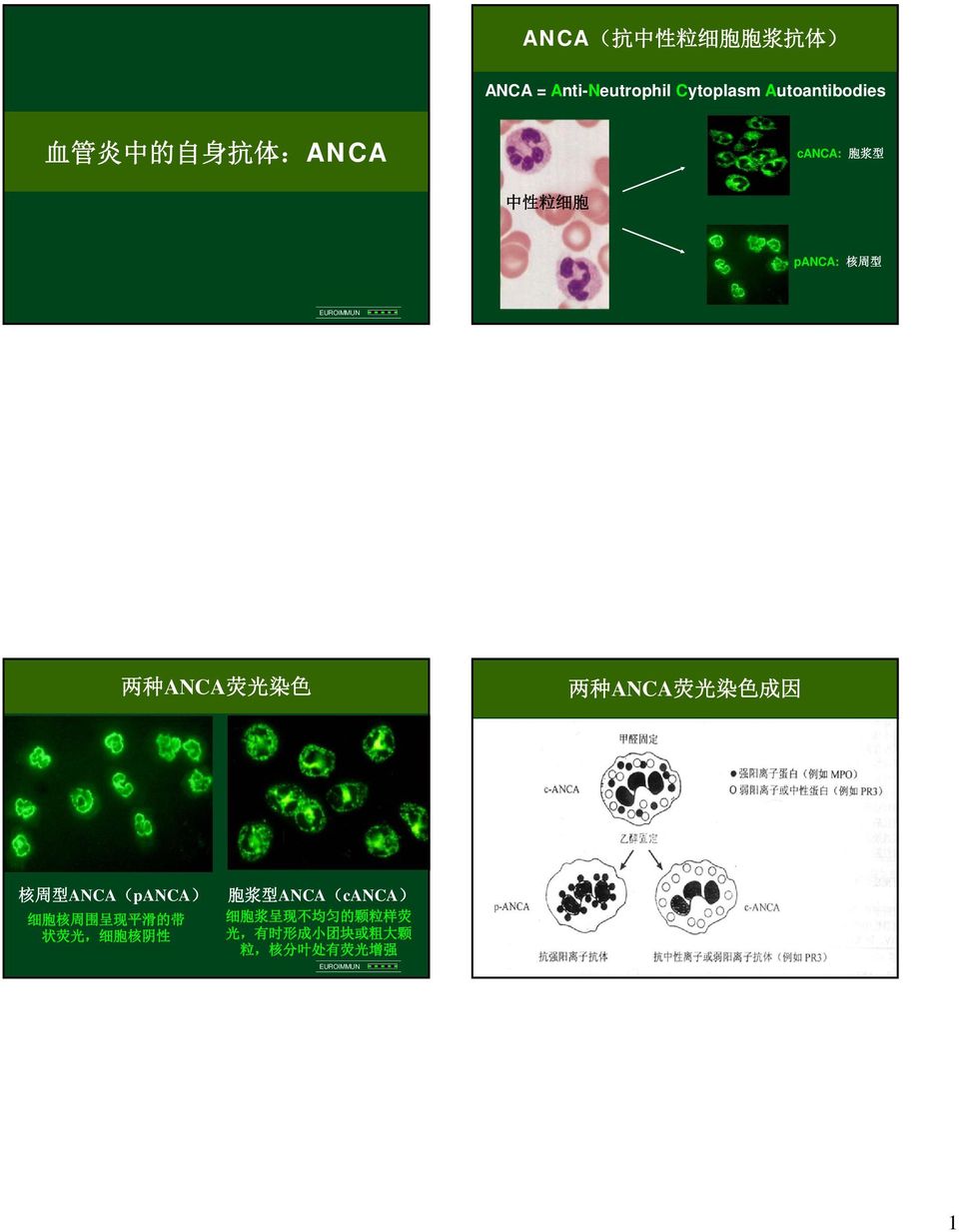 ANCA 荧 光 染 色 成 因 核 周 型 ANCA(pANCA) 细 胞 核 周 围 呈 现 平 滑 的 带 状 荧 光, 细 胞 核 阴 性 胞 浆 型