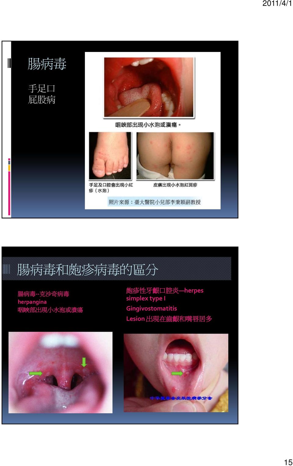 皰 疹 性 牙 齦 口 腔 炎 herpes simplex type I