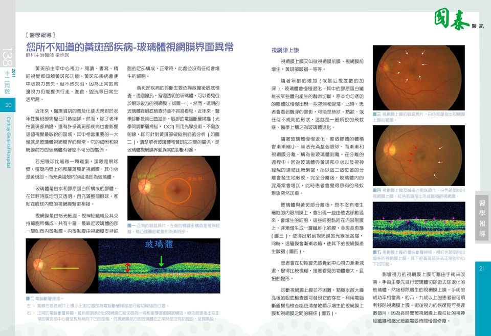 眼部的電腦斷層掃描 ( 光 任何不規則的形狀 這就是一般所說的飛蚊 性黃斑部病變 還有許多黃斑部疾病也會影響 學同調斷層掃描 OCT) 利用光學技術 不需放 症 醫學上稱之為玻璃體退化 這個視覺最敏銳的區域 其中相當重要的一大 射線 即可針對黃班部做縱剖面的分析 ( 如圖 類就是玻璃體視網膜界面異常 它的成因和視 二 ) 清楚解析玻璃體和黃班部之間的關係 是 網膜前方的玻璃體有著密不可分的關係