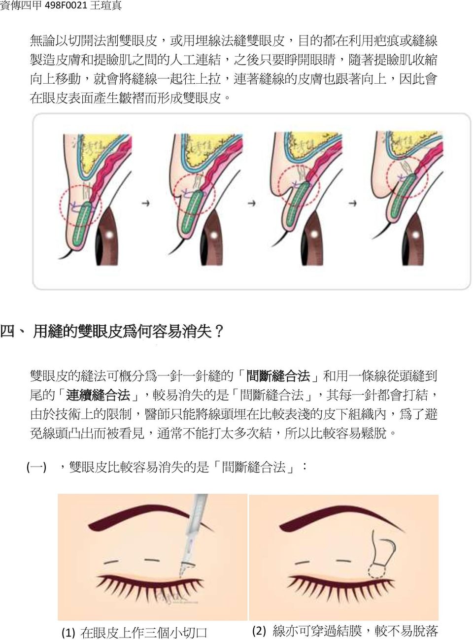 雙 眼 皮 的 縫 法 可 概 分 為 一 針 一 針 縫 的 間 斷 縫 合 法 和 用 一 條 線 從 頭 縫 到 尾 的 連 續 縫 合 法, 較 易 消 失 的 是 間 斷 縫 合 法, 其 每 一 針 都 會 打 結, 由 於 技 術 上 的 限 制, 醫 師 只 能 將