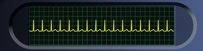 阵发性室上性心动过速 房室结折返性心动过速的心电图 : 1. 心率 140-250 次 / 分, 节律整齐 ; 2. QRS 形态可正常或畸形 3.
