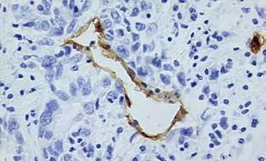 382 ISSN 1009-3079 CN 14-1260/R,,,. A B C D N 图 3 肿瘤浸润神经与微血管的关系 (A-B: CD34 400; C-D: CD34 100). 质着色, 为棕褐色颗粒状 ; 血管不染色 ( 图 4A-B).