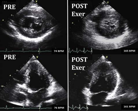 图 26 一名 13 岁的三尖瓣闭锁和单心室病人的运动超声心动图, 静息时 (PRE) 和峰值运动时 (POST Exer)
