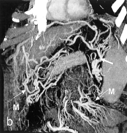 Tributaries of the portal vein are the splenic vein, superior mesenteric vein, inferior mesenteric vein, left gastric vein, right gastric vein, pancreaticoduodenal vein and cystic vein.