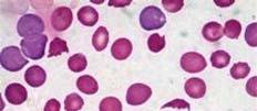 四 贫血 主要临床表现 特征 : 微血管病性溶血性贫血 外周血中裂体细胞