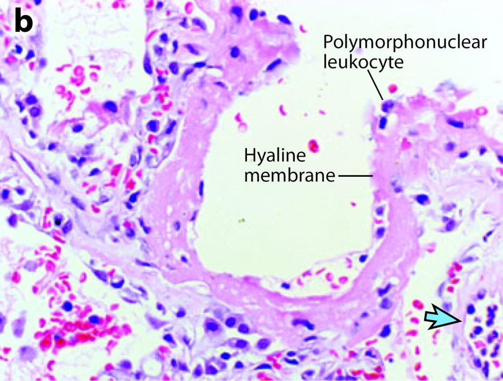 alveolar-capillary membrane. A higher-power view of a different field illustrates a dense hyaline membrane and diffuse alveolar inflammation.