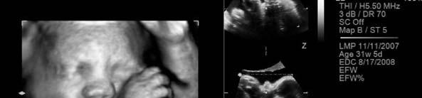 3D ultrasound imaging
