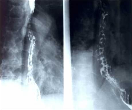 第三节 X 线胃肠道造影影像诊断 模拟试题 1: 病史 : 患者男性,66 岁, 呕血