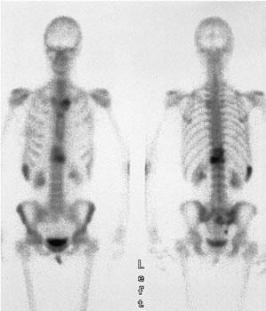 放射性同位素骨掃描 Radioisotope bone scan