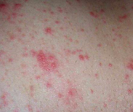 2. 透发麻疹, 风疹瘙痒 : 用于麻疹初期 顺证 : 发热, 面部