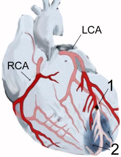 A heart attack 心肌梗塞 often involves a clot in the coronary arteries or their branches.