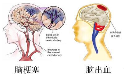 高血压病概述 高血压的并发症 根据流行病学调查估计, 目前中国有 : 1.600 万脑中风幸存者, 每年新增 250 万 ; 2.