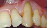 术的种植手术, 以恢复美学区外观 结论内牙周牙髓联合病变,