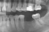 牙缺失后, 邻牙位置偏离, 故入院接受治疗