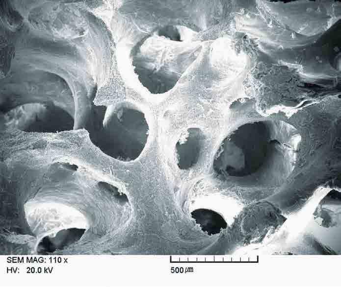 骨生成是指通过自体骨进行骨再生的方法 自体骨作为 代, 这个过程就被称为骨传导过程 骨移植材料既起到支架的作用, 同时又为骨再生提供必要的生长因子和再生细胞 骨诱导 安全性 高孔隙率 骨传导 骨诱导概念由 Urist 在 1971 年首次提出, 指骨形成蛋白 (BMP) 或其他生长因子等骨传导细胞分化为成骨细胞, 进 目前市面上的各类骨移植材料, 虽已经历了较长的流通时间,