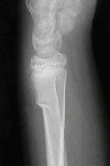 儿童骨折的特点 : 青枝骨折 : 原因 : 长骨的有机成分多, 骨骼柔韧性大, 轻