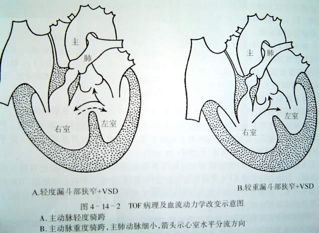 2 法乐氏四联症 (TOF) 法乐氏四联症是一种复杂的先天性心血管畸型,