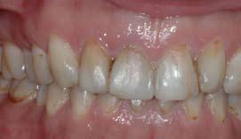 微创美容牙科 理念和治疗方式 的文章中得以解释, 因此, 在本篇文章中, 我只讨论微创美容牙科 MiCD 的核心原则 ( 表 2), 简要的介绍 MiCD 的治疗方案和临床技术 ( 图 2) 图 12a