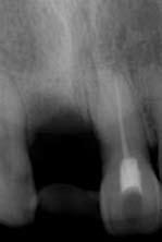 测量牙槽骨增加的高度和唇舌侧骨吸收量 冠修复后 15 个月对其牙龈附着水平 牙龈乳头分级和牙周探诊深度 (PD) 进行测量分析并观察牙龈附着水平 结果术 后 5 个月复查时,
