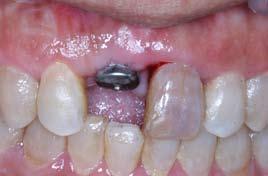 居住地济南主诉 : 上前牙缺失要求种植修复现病史 : 患者 1 月前外伤后拔除上前牙,