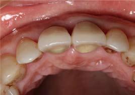 47 mm, 种植体颈部中心唇舌向的骨宽度为 6.