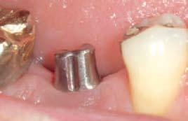Araújo MG, Lindhe J: Dimensional ridge alterations following tooth extraction.