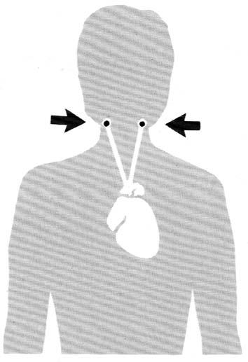 颈动脉窦综合征是颈动脉窦反射过敏引起的晕厥 常因局部炎症 外伤
