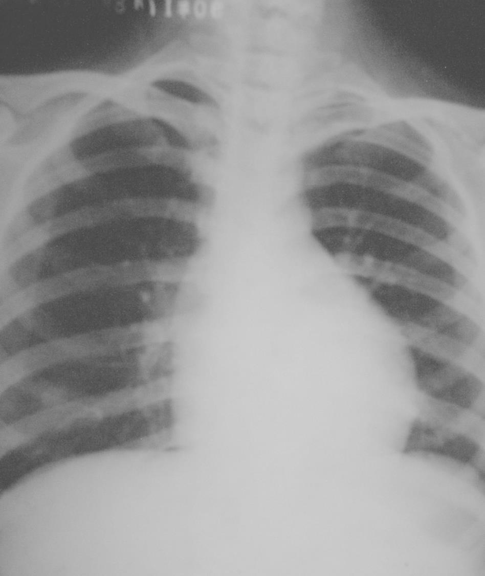 异常 X 线影像 ---- 心脏增大 二尖瓣心型 PA: 呈梨形, 心腰丰满,