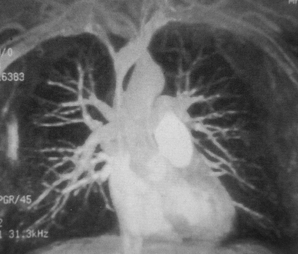 肺动静脉 MR