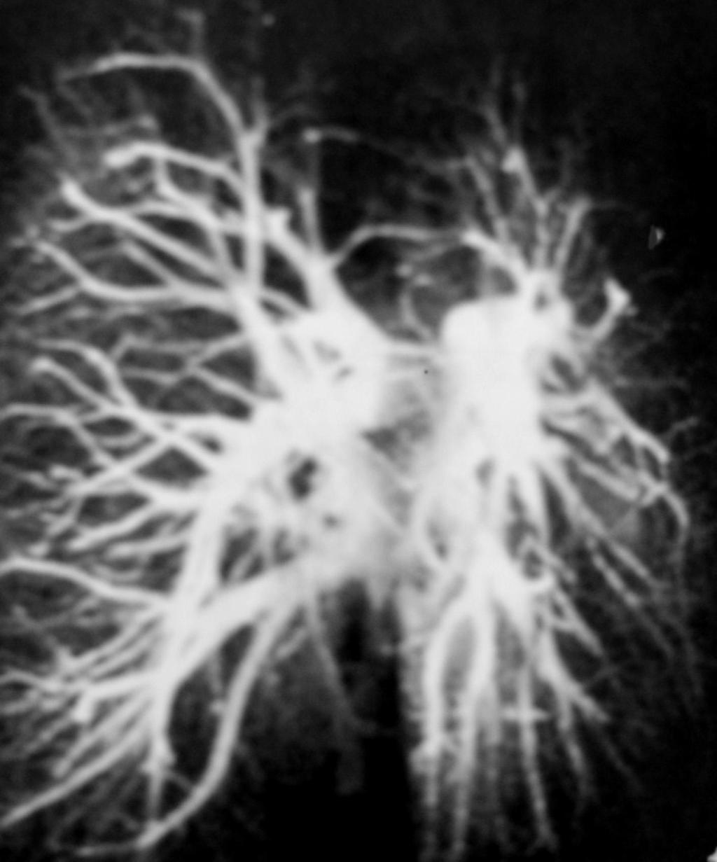 肺静脉 MRV