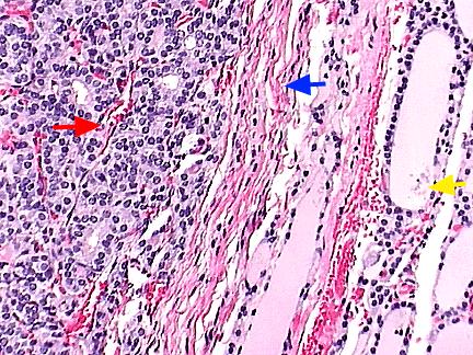 Simple adenoma The red arrow is located within the adenoma. Although composed of follicular cells, little colloid is seen.