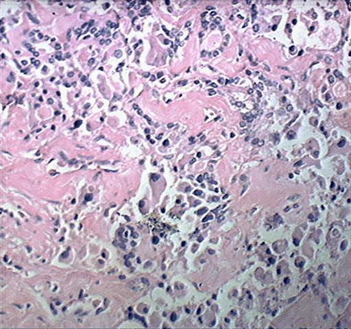Medullary Carcinoma of Thyroid 肿瘤细胞为圆形,