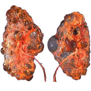 kidney disease (ADPKD) henryoshoremoh.