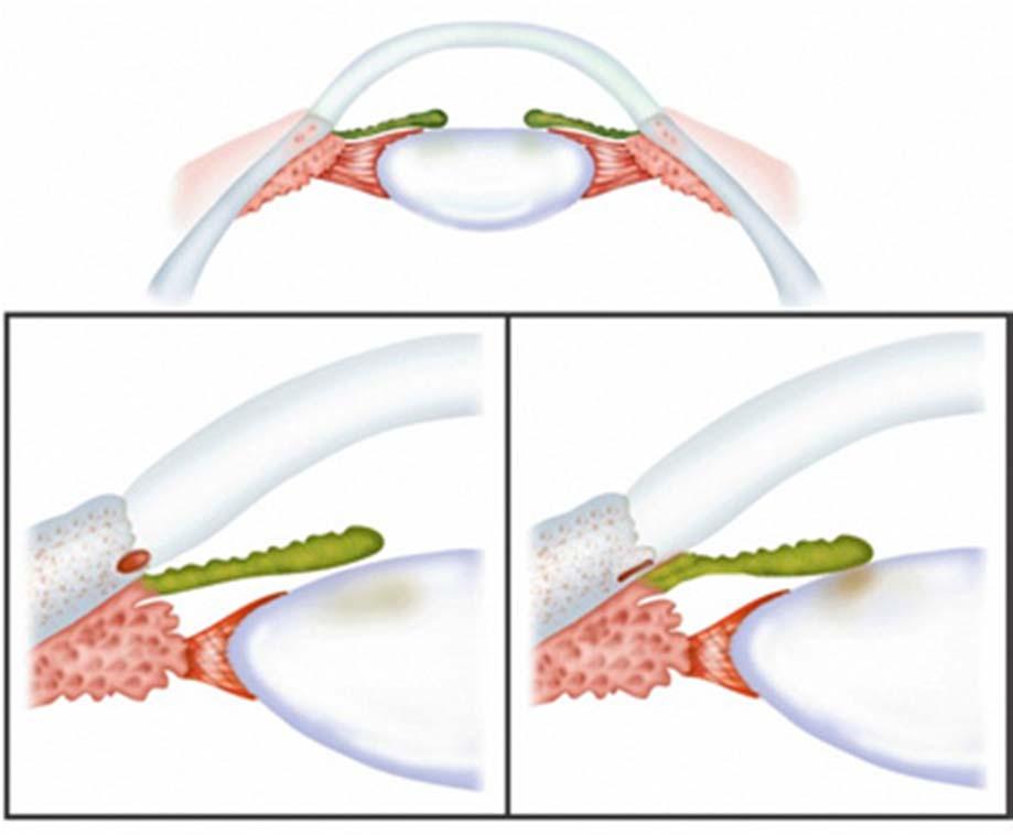 三 原发性开角型青光眼 病理生理与发病机制 房角开放 1. 小梁组织局部病变 2.
