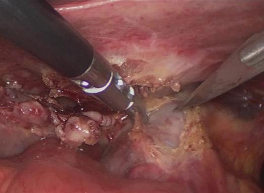 bile duct; B: Layer-by-layer interrupted suture of the incision of the common bile duct (closed wall of the common bile duct, and arrow showing the surface serosa waiting to be closed); C: View after