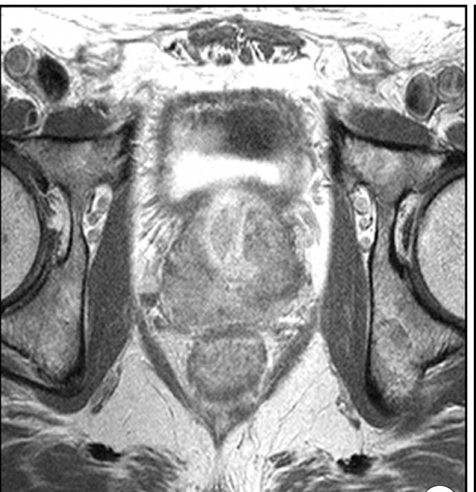 前列腺增生MRI图