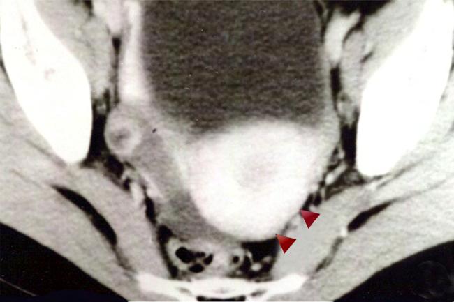 子宫 女性生殖系统正常 CT 表现 宫体 : 椭圆形软组织影, 中心宫腔.