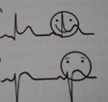 也是缺血型心电图改变的进一步发展或恶化 心电图变现为 ST