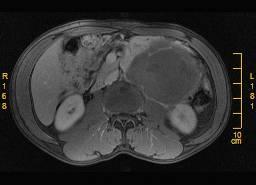 例发生于腹膜后左侧 8 例位于睾丸内的精原细胞瘤, 肿块大小为 1.