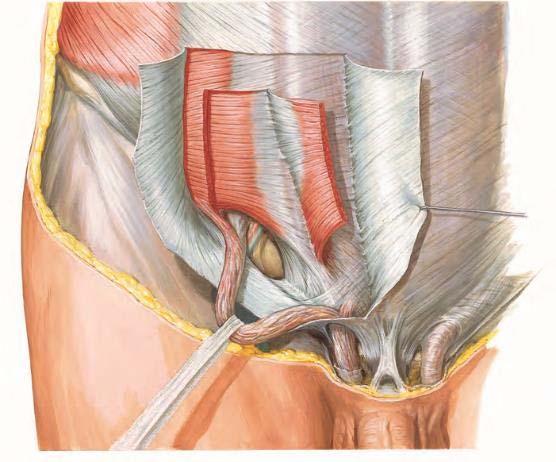 腹股沟管解剖 内环 : 精索或子宫圆韧带穿过腹横筋膜形成的一个卵圆形裂隙 外环 : 腹外斜肌腱膜纤维在耻骨结节上外方行程的一个三角形裂隙 前壁 :