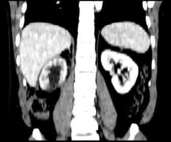 核小而圆, 未见核仁 ; 肾盂 肾盏及输尿管未见侵犯 图 3(b) 和图 3(c) 为同一病例镜检资料 2.