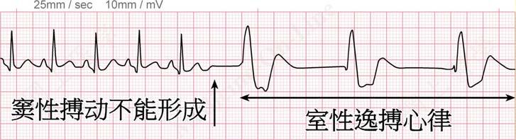 除极激动必需沿着房室结向上和向下传导相等的距离后使心房和心室除极 因此心房和心室的激动是同时的 ( 沿希氏束和左右束支向下传导的速度很快 ), 则 P 波被掩盖在 QRS