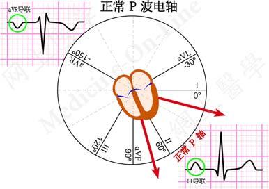 QRS 波群 第二个波段为 QRS 波群 典型的这一波群由一系列的 3 个偏离组成, 它们反映了与左右心室除极相关的电流
