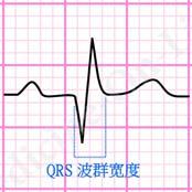 ( 三个小格 ) 与 P 波电轴一样, 正常 QRS