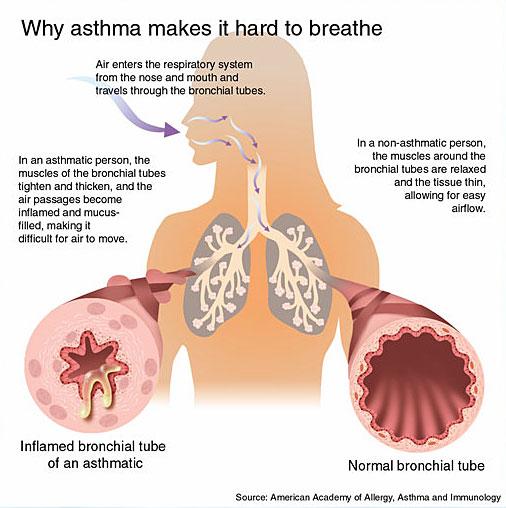 Allergic asthma 40 http://trialx.